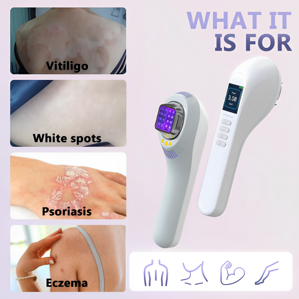 TreatSmart 308nm UVB Phototherapy Lamp for Vitiligo and Psoriasis